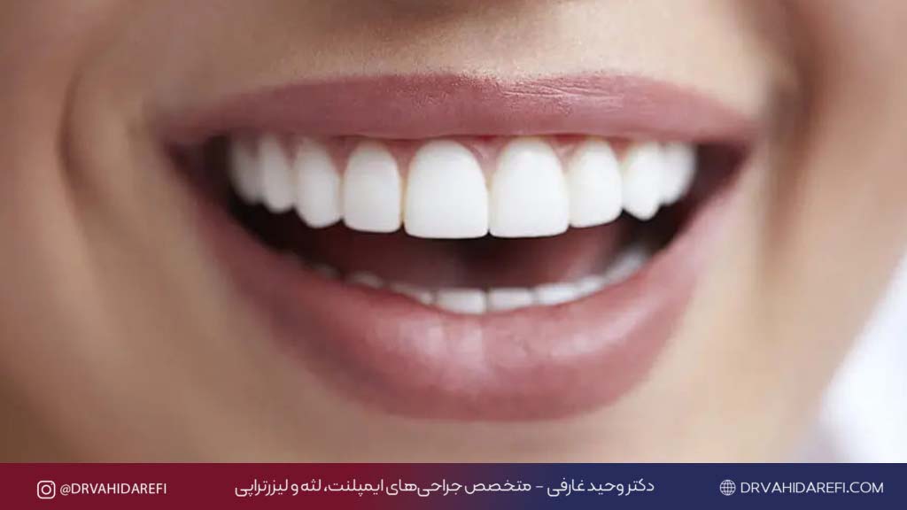 کامپوزیت 3 1