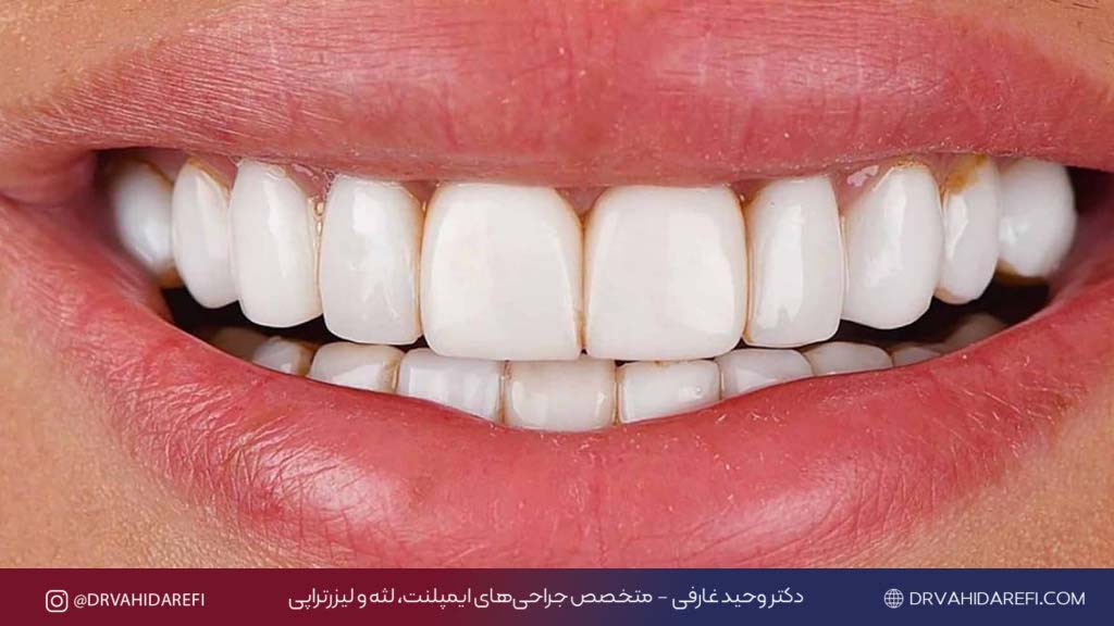 کامپوزیت 4 1