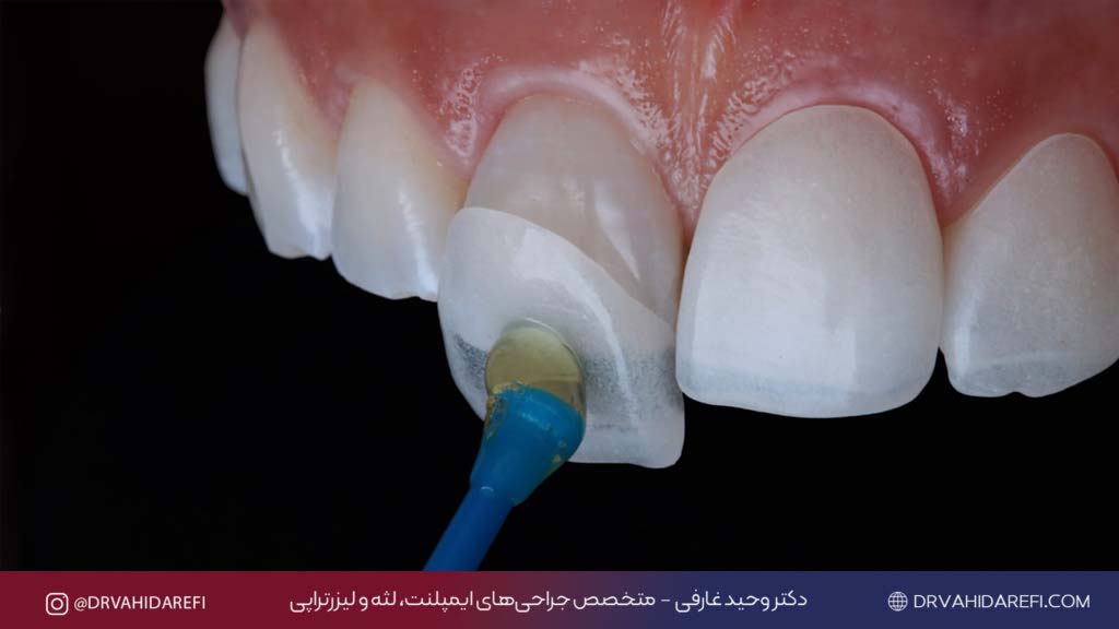 کامپوزیت 5 1