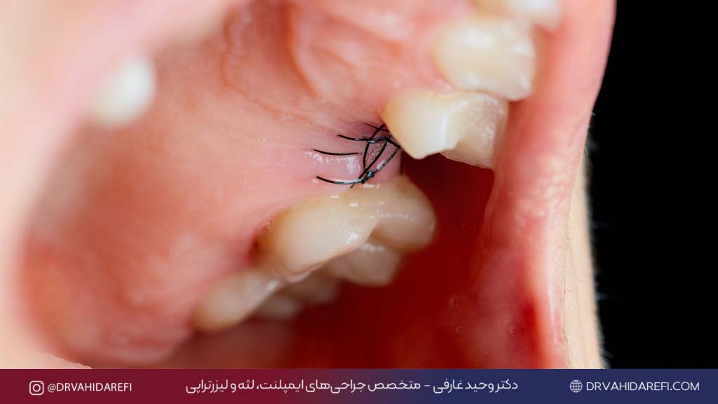 درمان جای دندان کشیده شده ترمیم لثه بعد از کشیدن دندان دکتر وحید عارفی 1