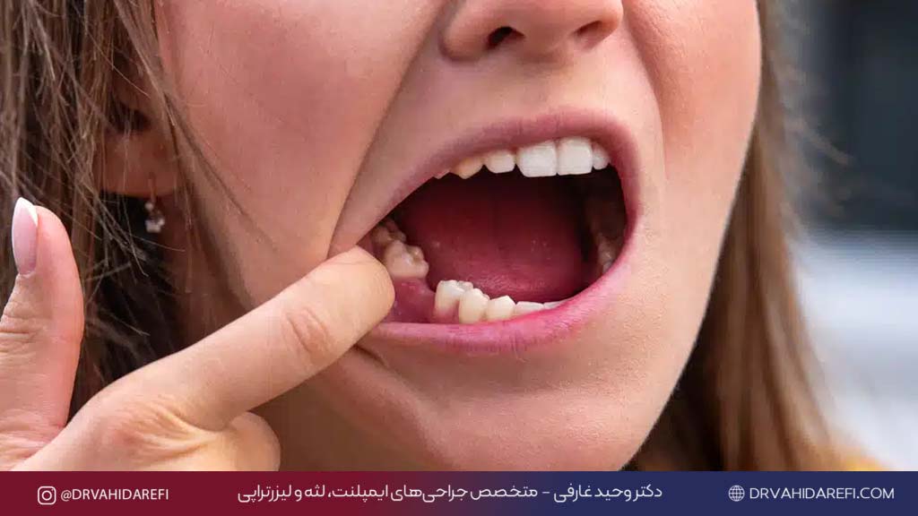 درمان جای دندان کشیده شده ترمیم لثه بعد از کشیدن دندان دکتر وحید عارفی 2