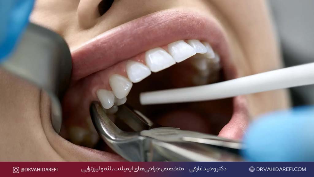 درمان جای دندان کشیده شده ترمیم لثه بعد از کشیدن دندان دکتر وحید عارفی 4
