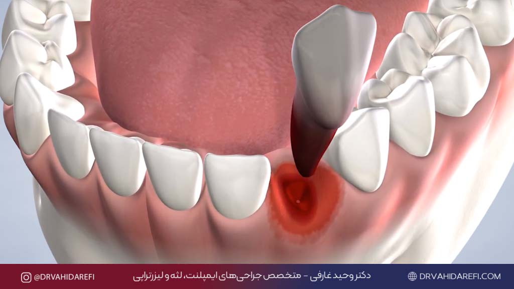 درمان جای دندان کشیده شده ترمیم لثه بعد از کشیدن دندان دکتر وحید عارفی 5