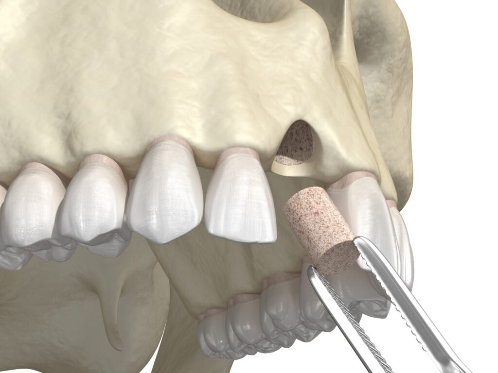dental bone graft