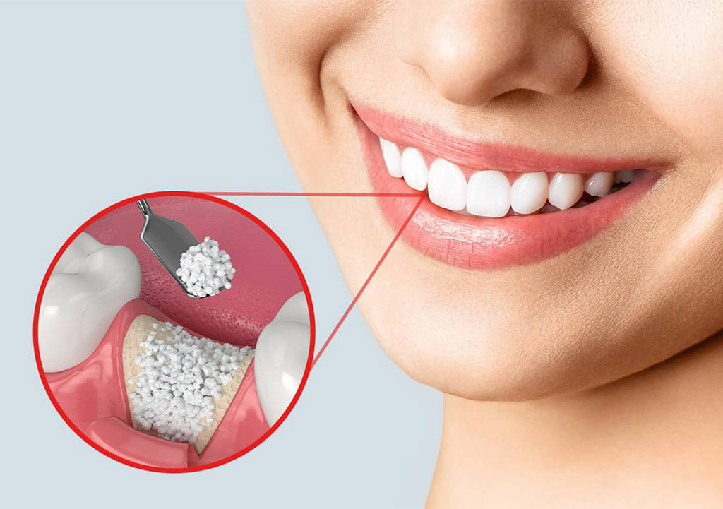 مراقبت پس از پیوند استخوان فک