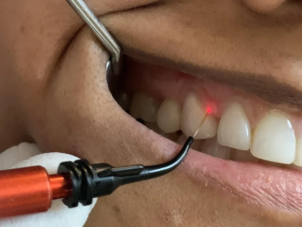 لیزر درمان پریودنتال در تهران | متخصص لثه و لیزر – دکتر وحید عارفی لیزر درمان پریودنتال