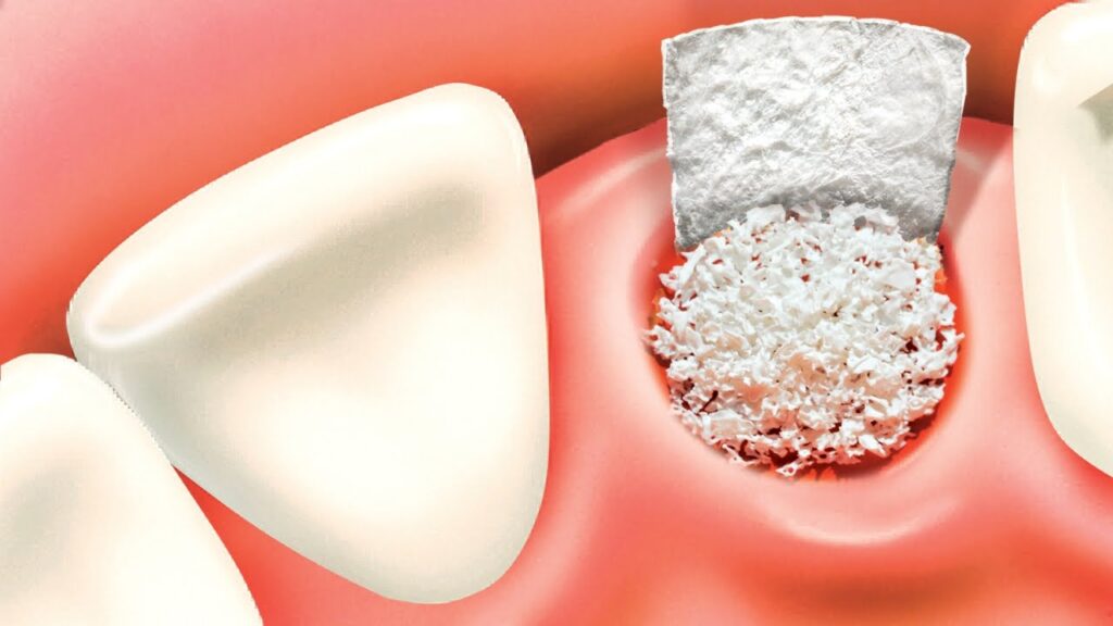 synthetic dental bone graft substitute