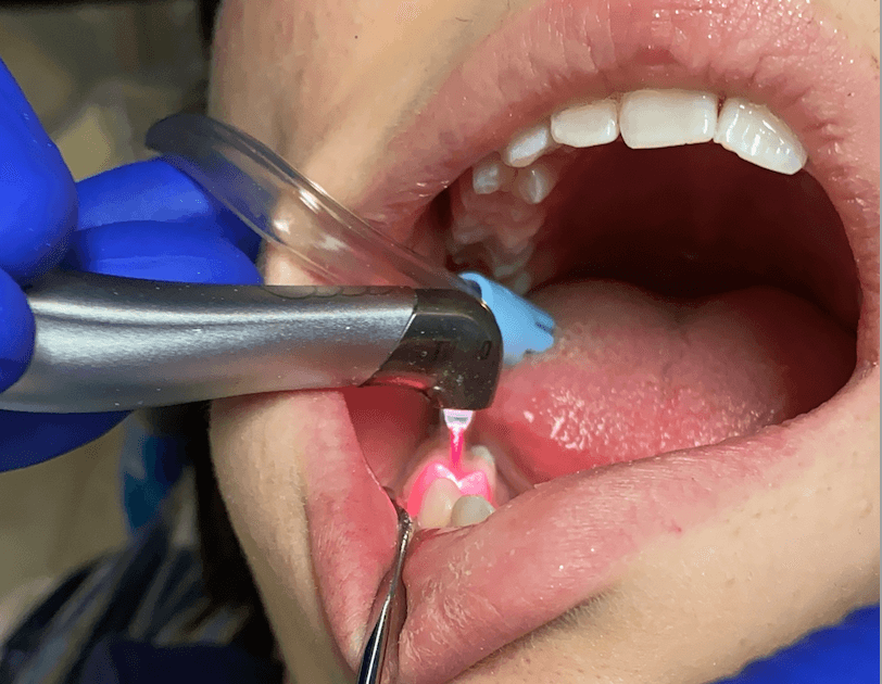 لیزر درمان پریودنتال در تهران | متخصص لثه و لیزر – دکتر وحید عارفی لیزر درمان پریودنتال