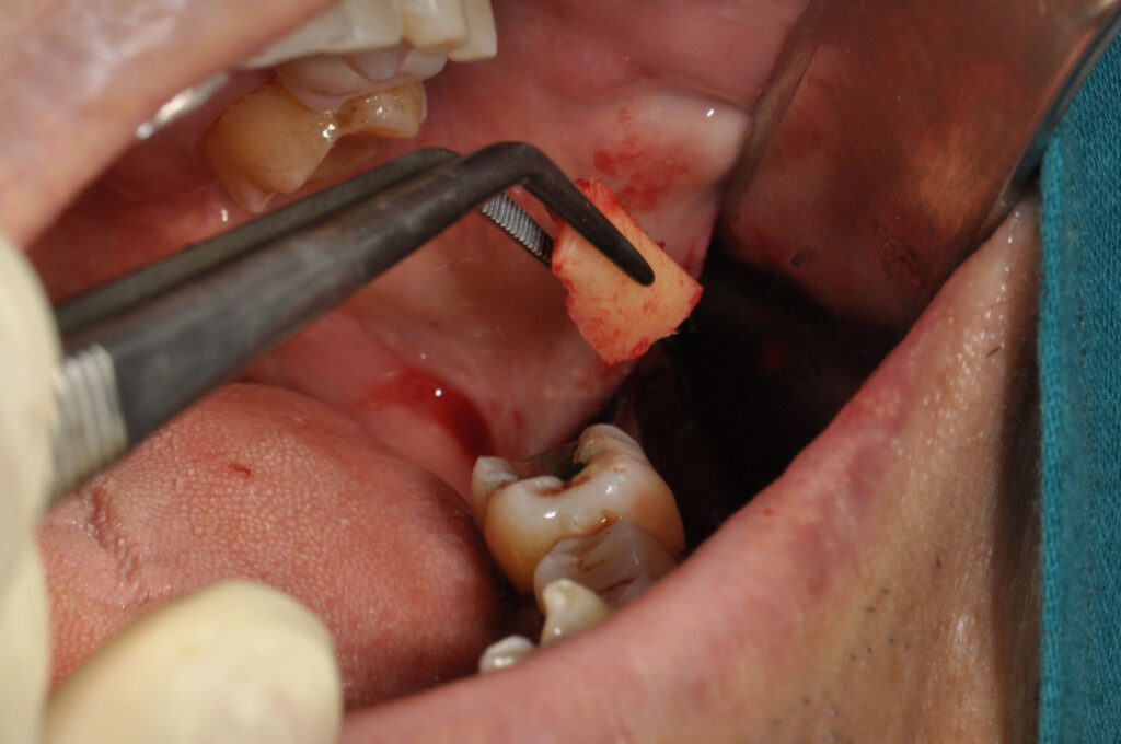 autologous bone graft