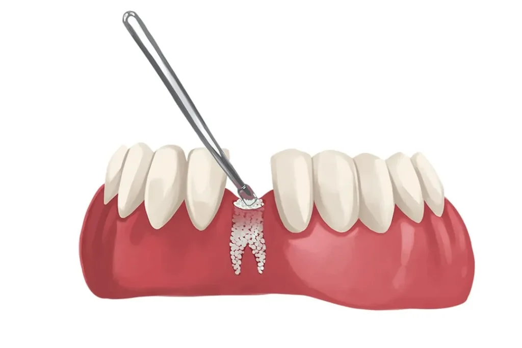 bone graft required due to bone loss