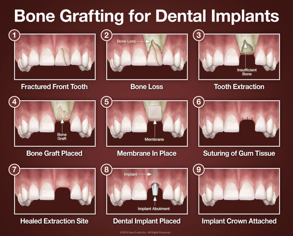 bone grafting for dental implants large
