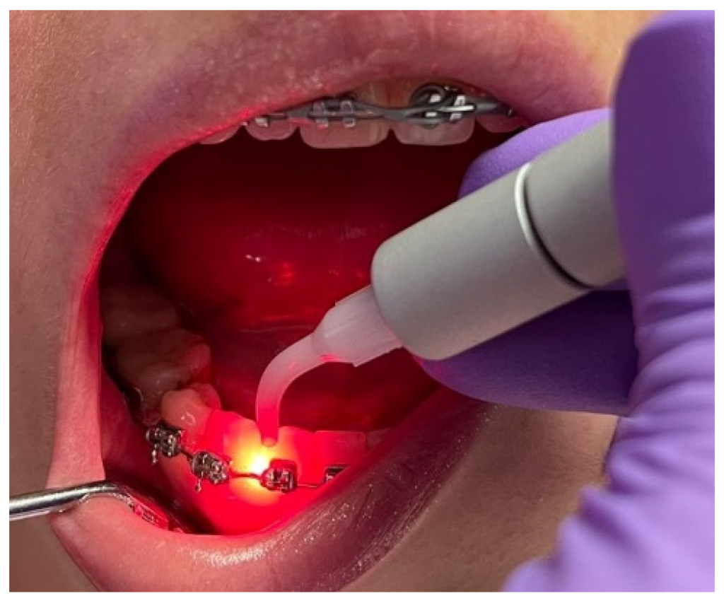 لیزر درمان پریودنتال در تهران | متخصص لثه و لیزر – دکتر وحید عارفی لیزر درمان پریودنتال