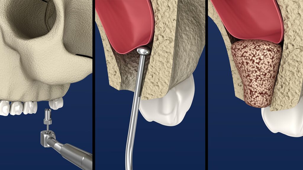 sinus lift photo