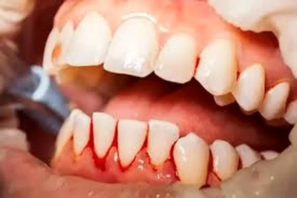 لیفت لثه چگونه است