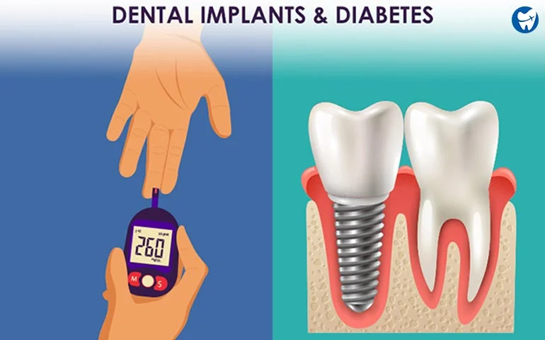 ایمپلنت دندان در بیماران دیابتی