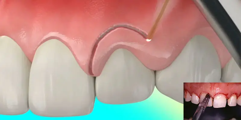 لیفت لثه چگونه است