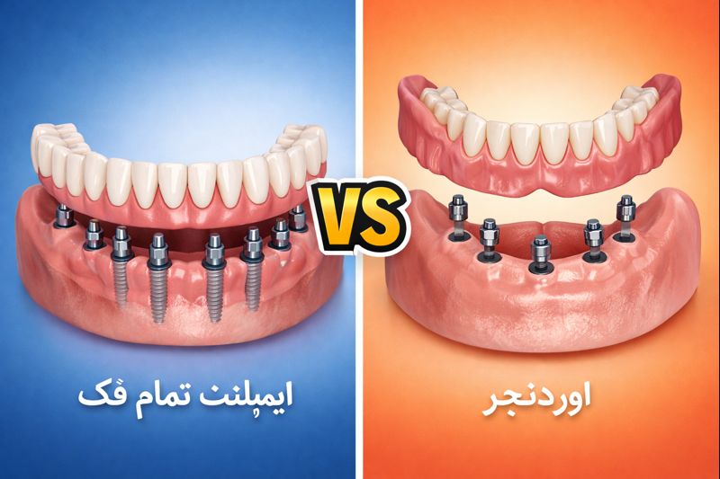 مقایسه ایمپلنت تمام فک و اوردنچر
