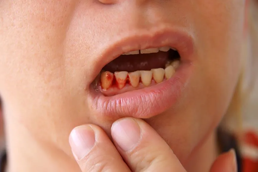علائم بیماری لثه؛ خونریزی و التهاب و تحلیل لثه