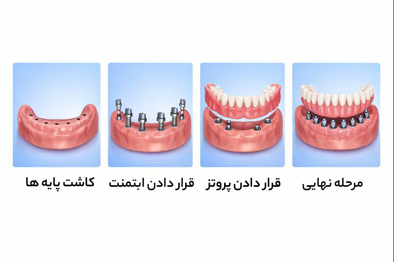 مراحل ایمپلنت تمام فک
