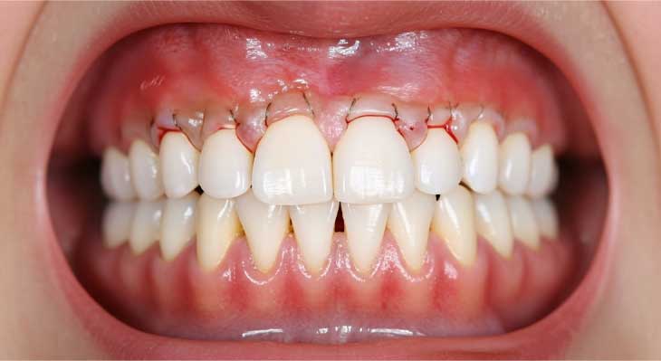 پیوند لثه برای ایمپلنت