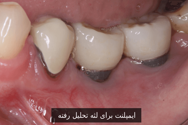 پیوند لثه برای ایمپلنت