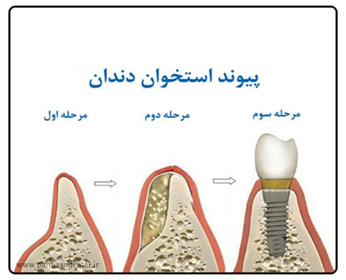 تحلیل استخوان فک در ایمپلنت