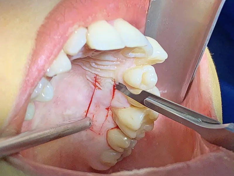 پیوند لثه برای ایمپلنت